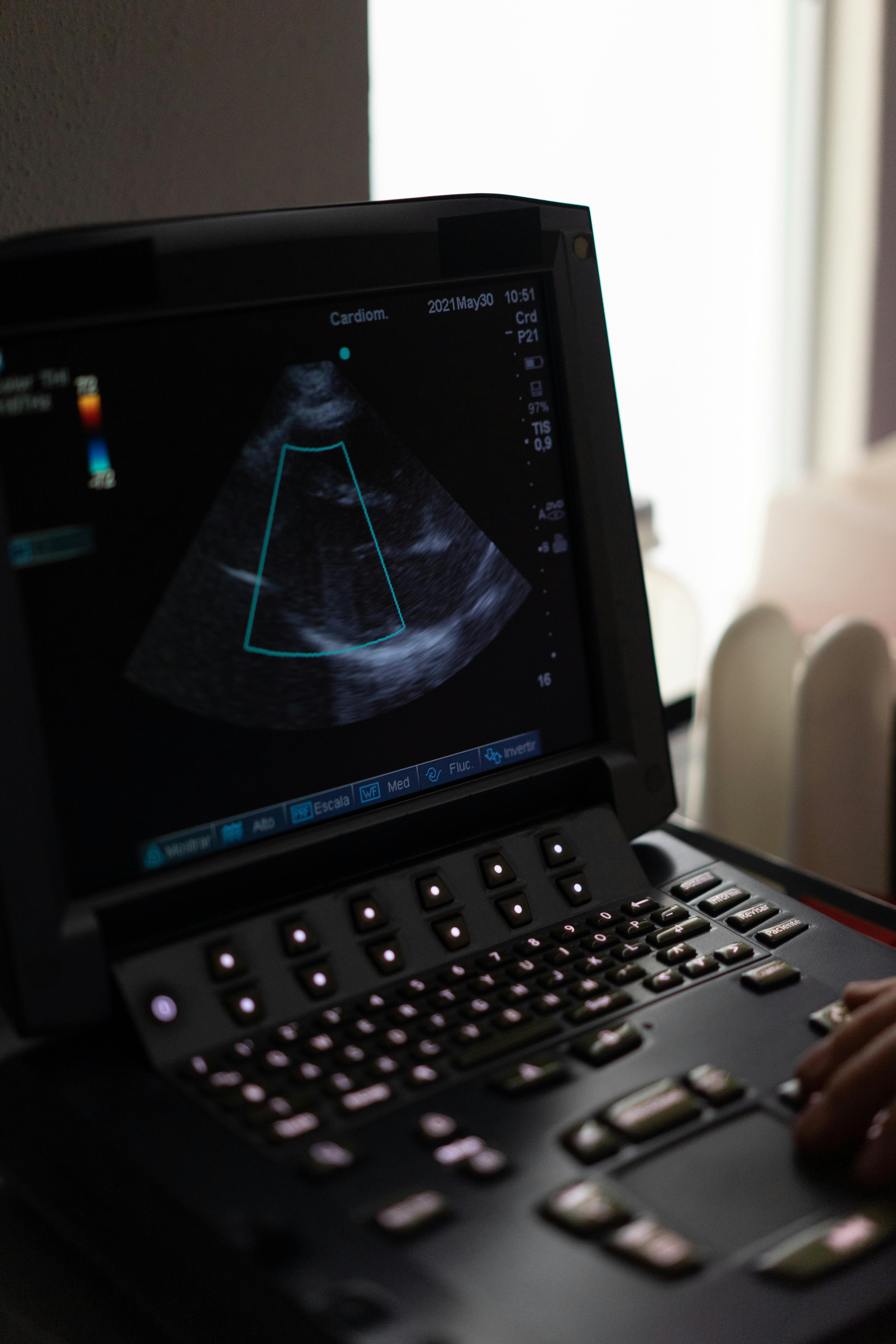 Ultrasound machine screen showing a cardiogram in a clinical environment